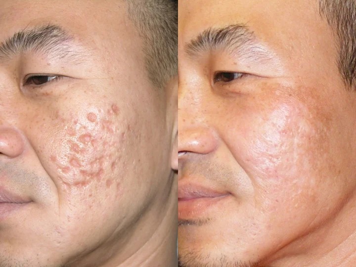 Severe on sale acne scars