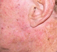 Photodynamic therapy.001 Photodynamic therapy.001
