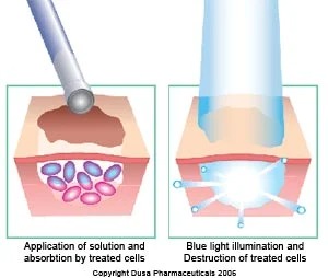 Photodynamic Therapy Boulder Co Ideal